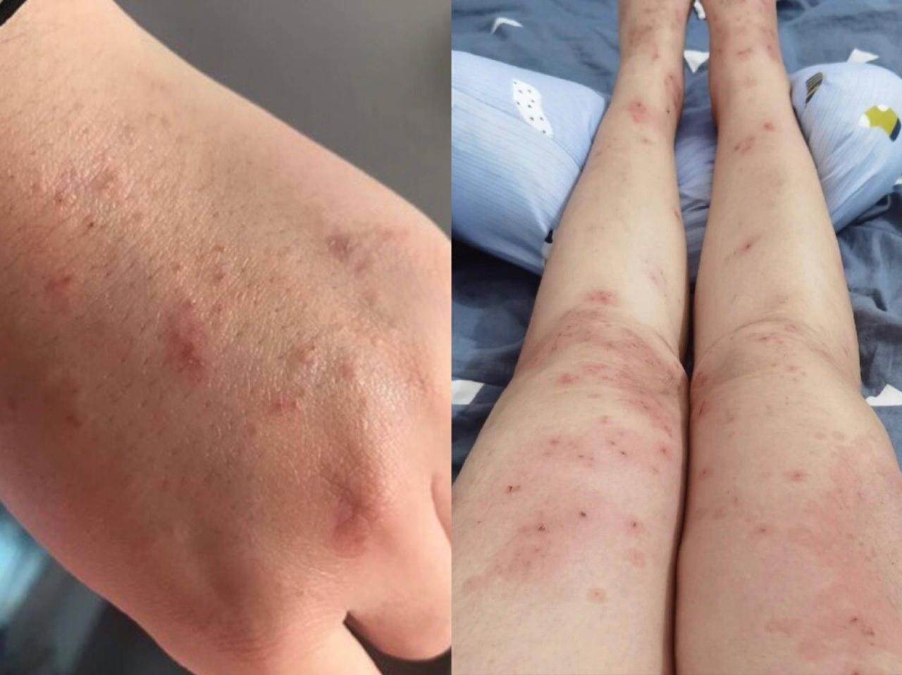湿疹皮肤瘙痒长疹怎么办？掌握这3个方法，分分钟拥有健康皮肤