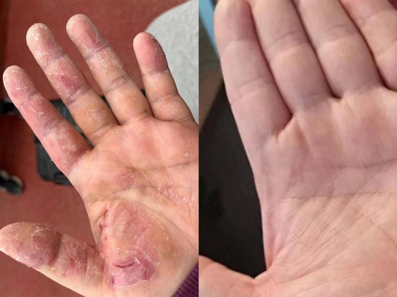 湿疹最怕它！每天早晚这样用，消疹止痒也就一个月