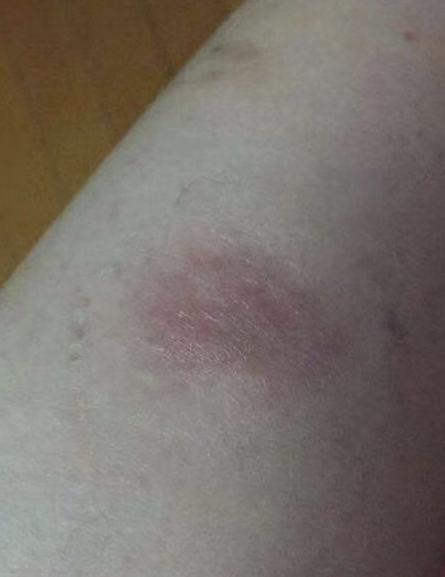 爱玩女孩三年战湿自述,千转百回终摆脱湿疹,也让我有所收获!