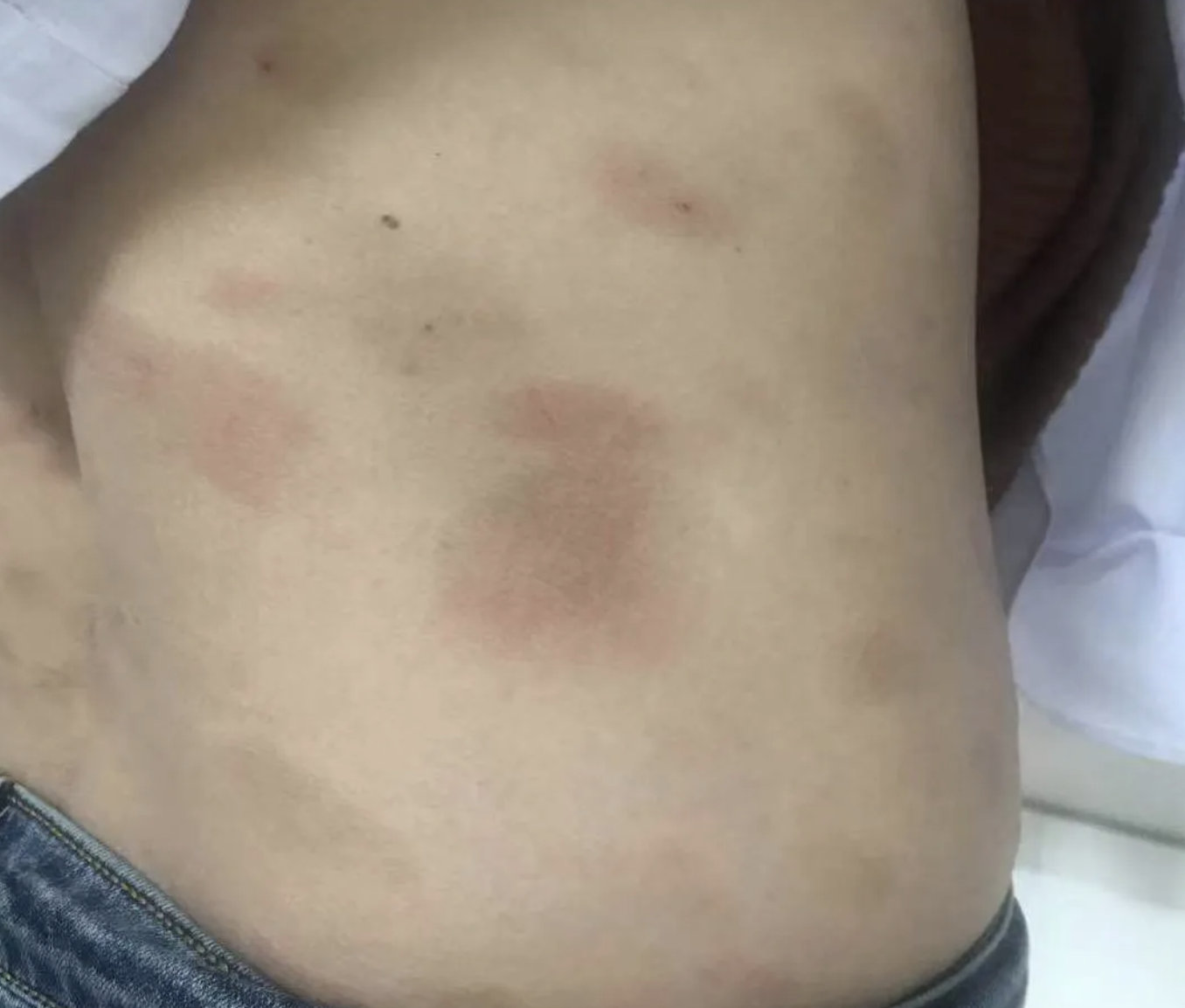 爱玩女孩三年战湿自述,千转百回终摆脱湿疹,也让我有所收获!