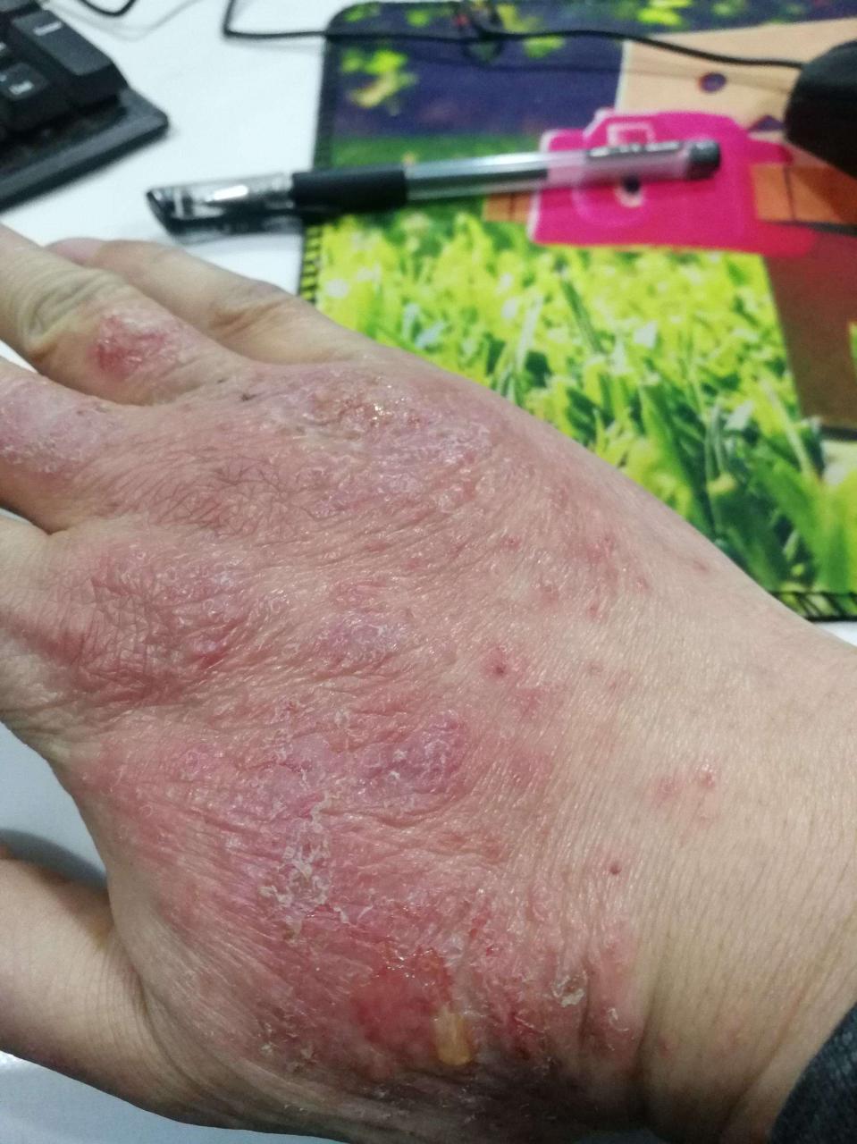急性湿疹
