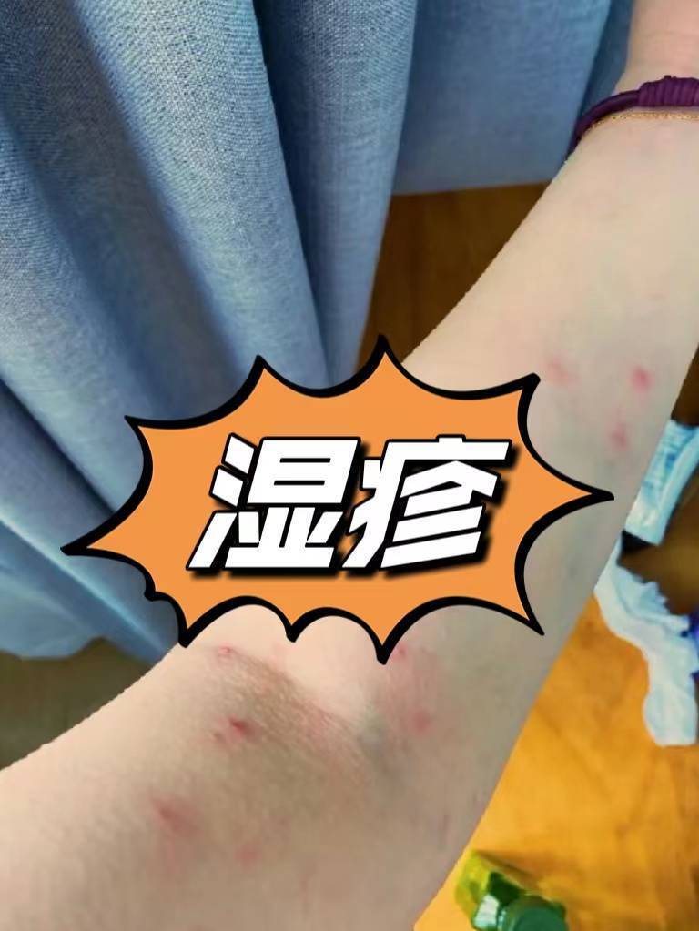 拒绝踩雷！被问了800遍的治疗湿疹小绝招！后悔没有早点知道！