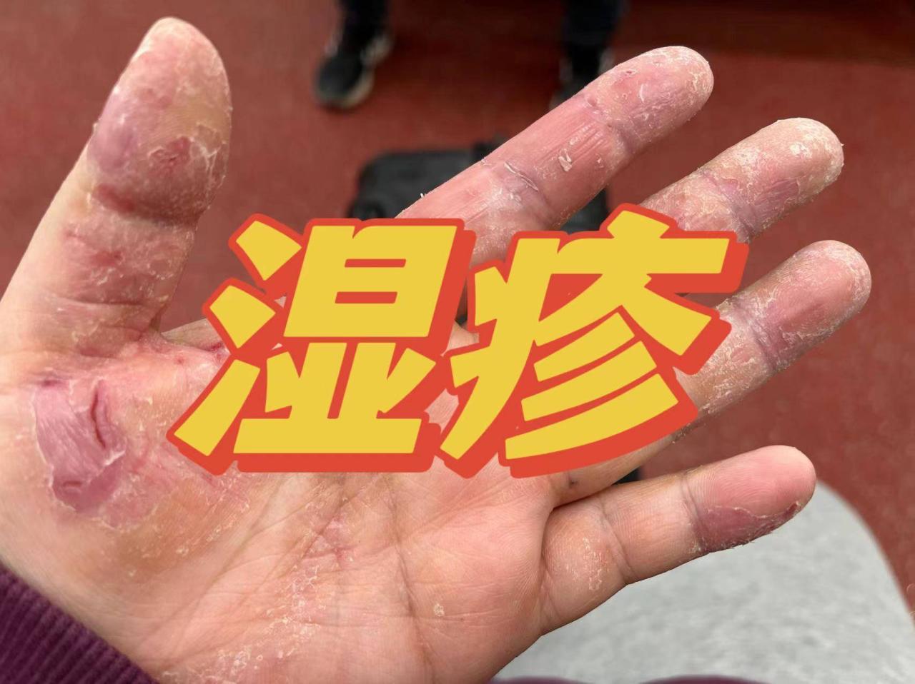 万万没想到！顽固湿疹没有再犯的原因竟是这个？过来人建议你赶紧收藏
