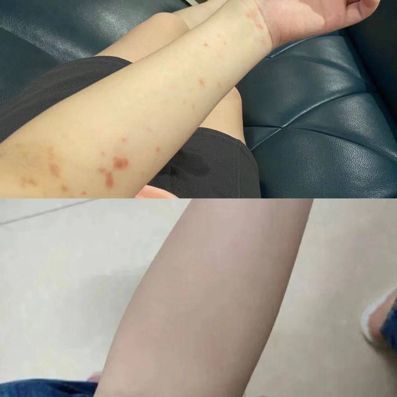 打死都不敢相信！湿疹竟然这么简单就治好了！不看吃大亏了