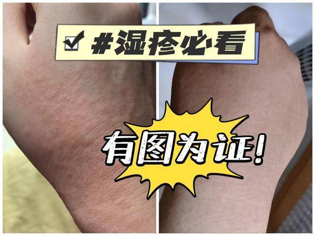 再发最后一遍！被问了800遍的祛湿疹妙招，亲测有效不踩雷
