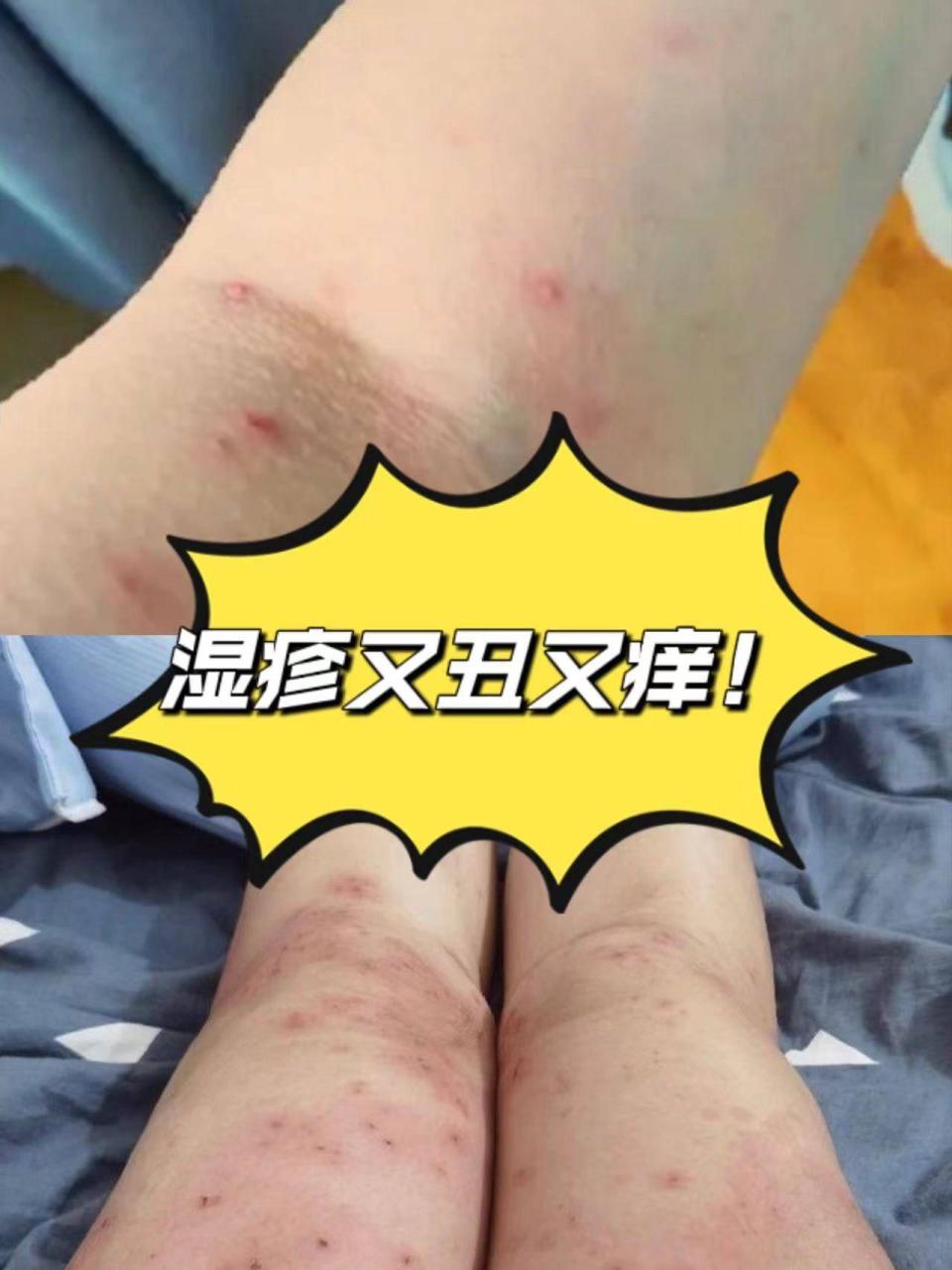 拒绝踩雷！被问了800遍的治疗湿疹小绝招！后悔没有早点知道！