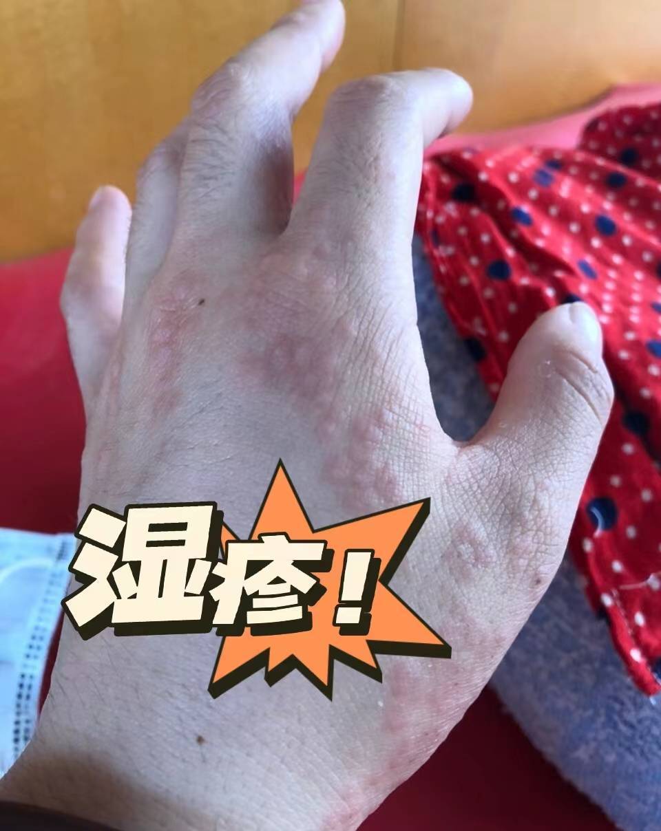 万万不敢相信！解决湿疹只需这一招！有图有真相赶紧去看！
