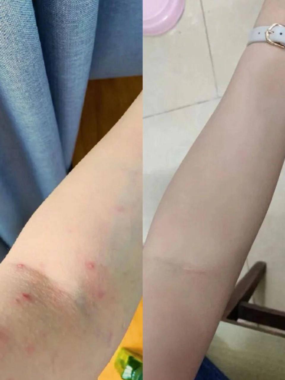 拒绝踩雷！被问了800遍的治疗湿疹小绝招！后悔没有早点知道！