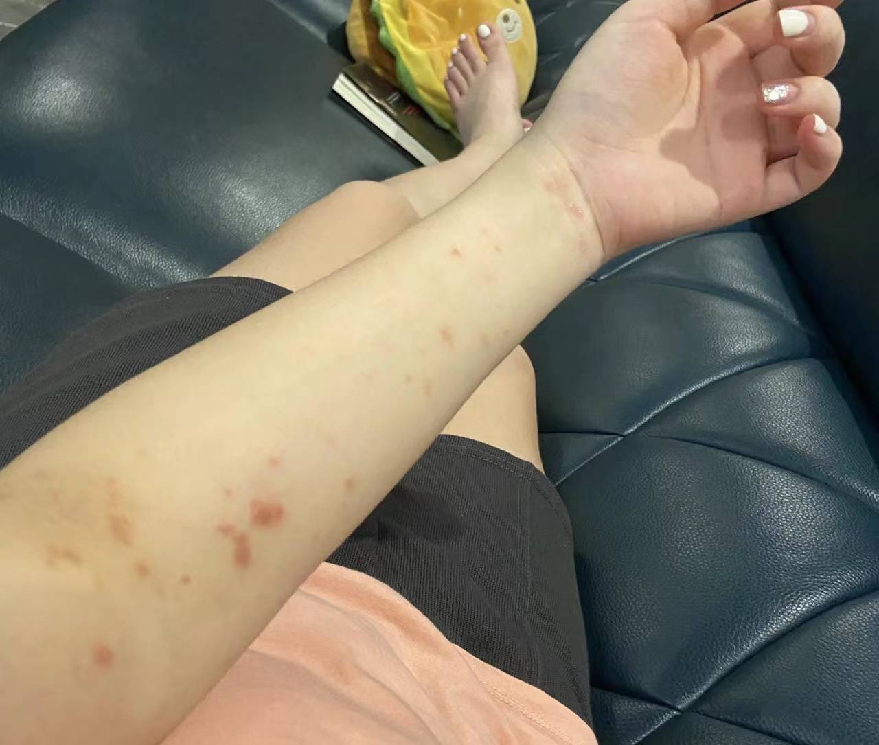 长疹瘙痒怎么办？几块钱的维生素竟有如此奇效！去除湿疹真是太简单了