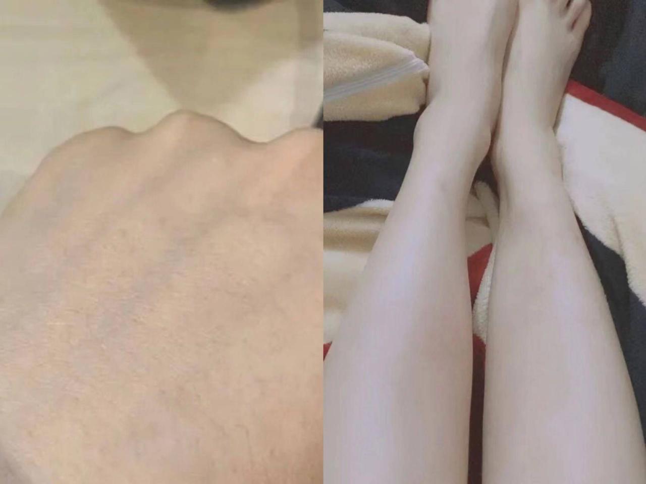 千万别错过！湿疹瘙痒抓挠不止？资深湿疹患者分享治愈经验！