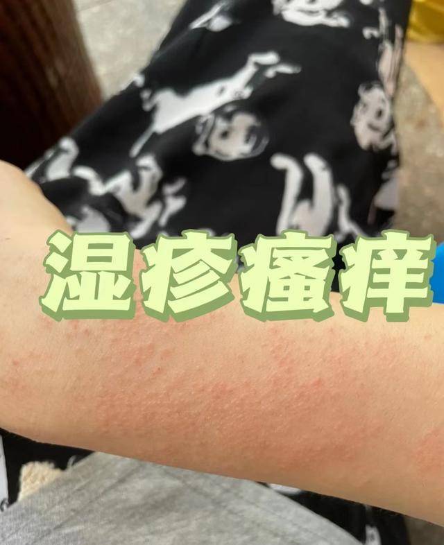五年湿疹辛酸史！想要成功祛湿止痒，这三招还真少不了！