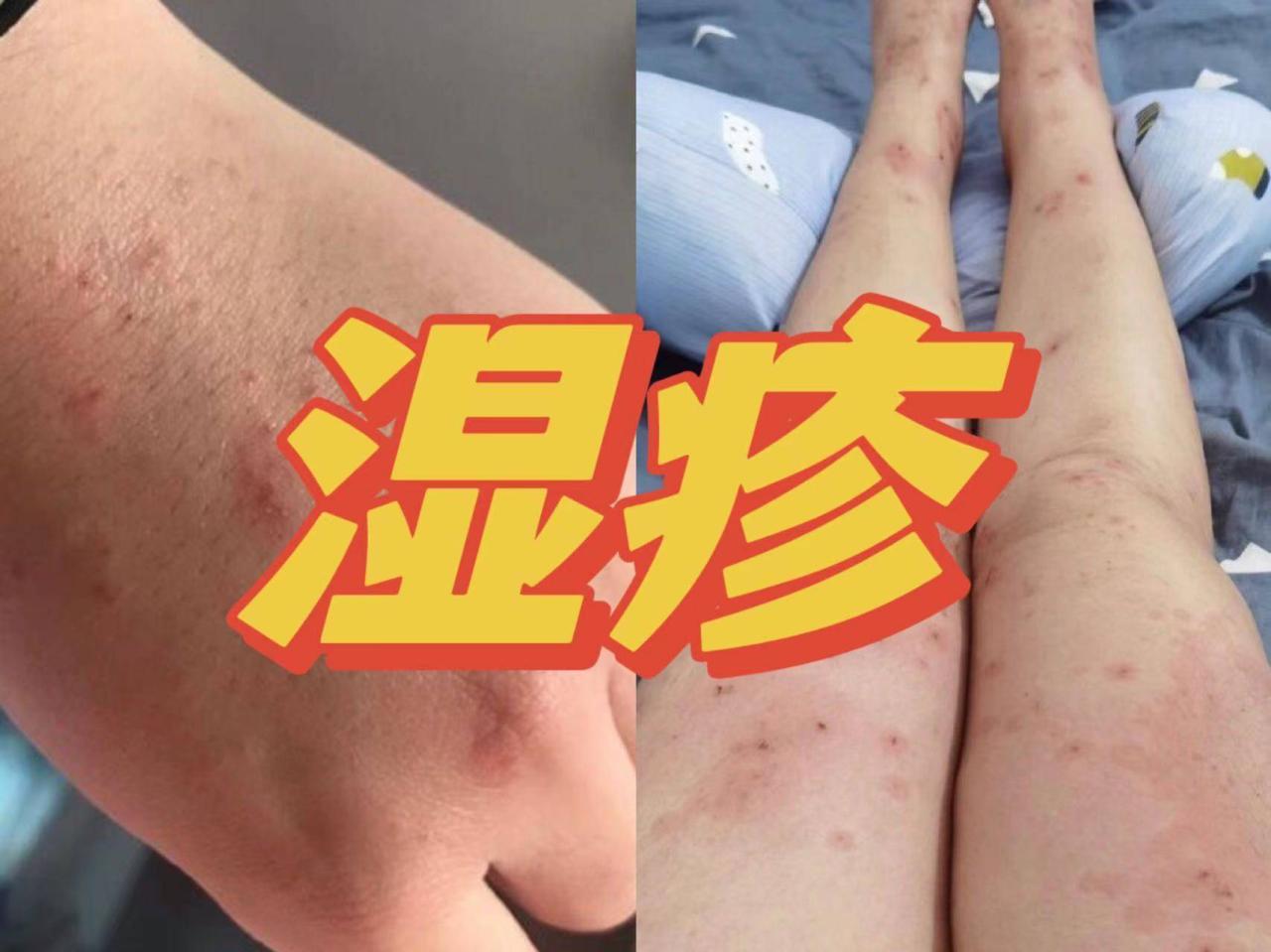 皮肤瘙痒不止？湿疹反复发做？随便教你几招！轻松去除顽固湿疹！