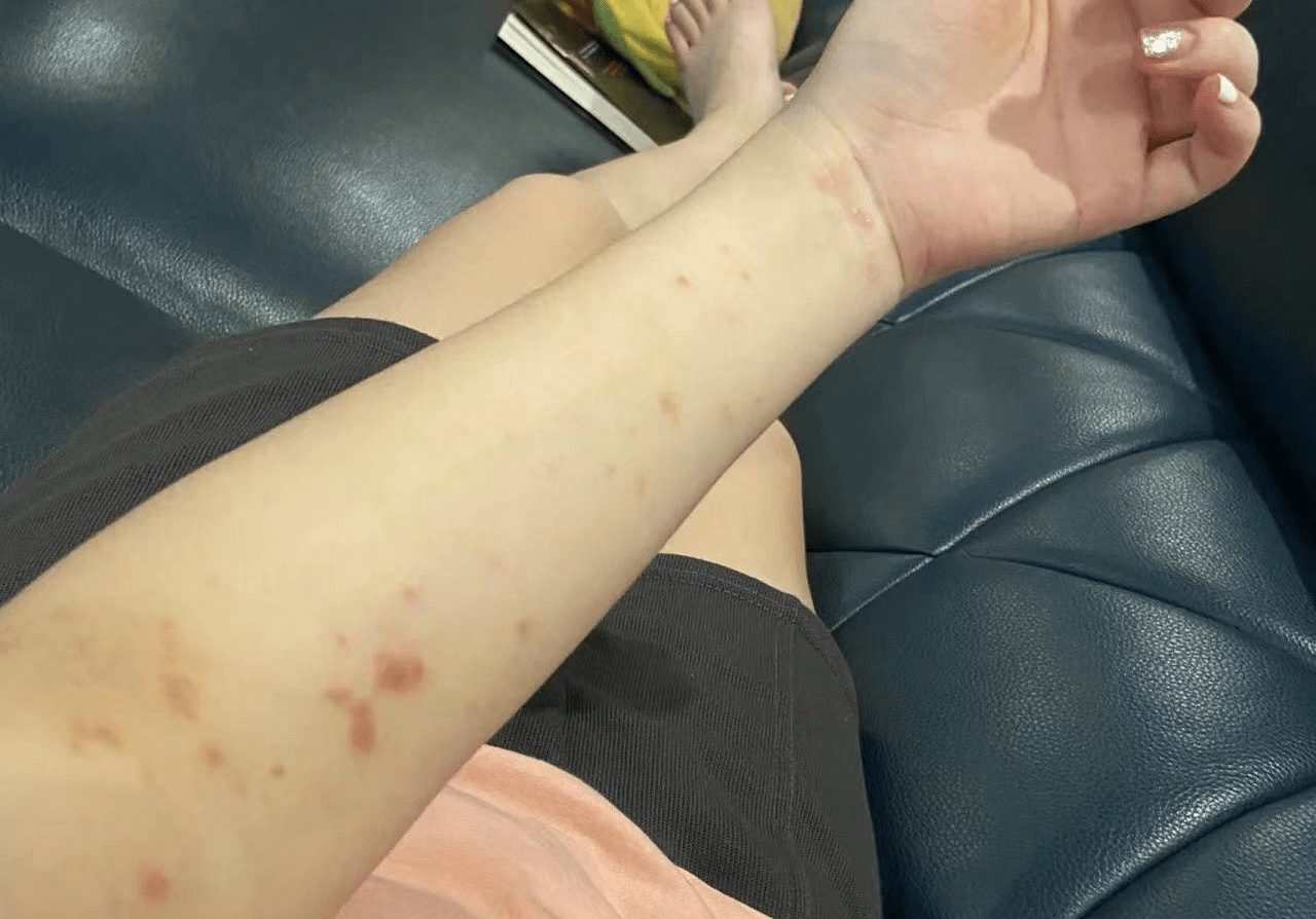 错过必悔！史上最全湿疹治愈指南！湿疹康复者吐血整理！