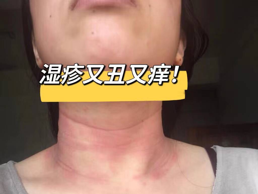 过来人亲测！超厉害的湿疹止痒法！我不允许湿疹止痒法折磨任何人！