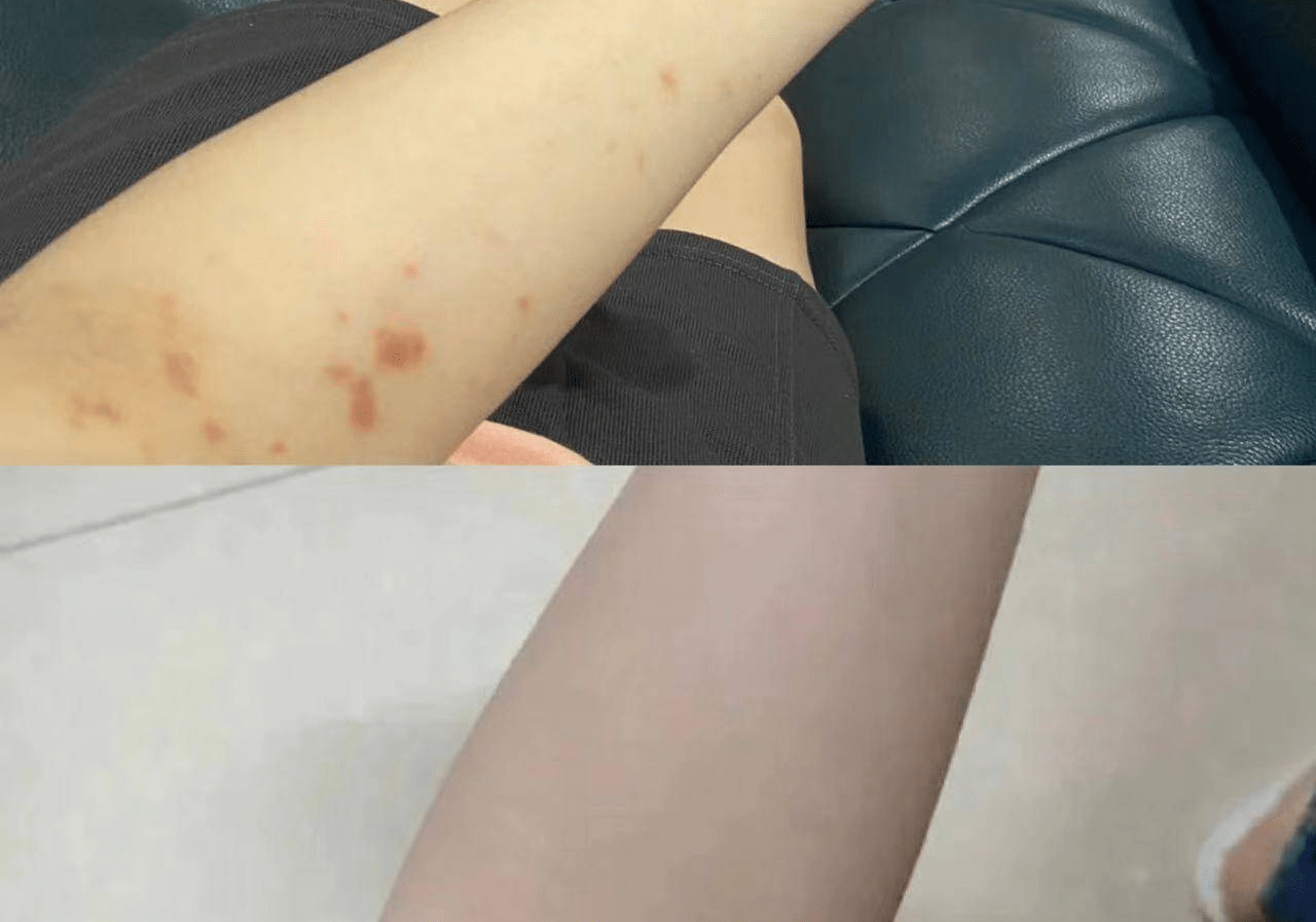 错过必悔！史上最全湿疹治愈指南！湿疹康复者吐血整理！