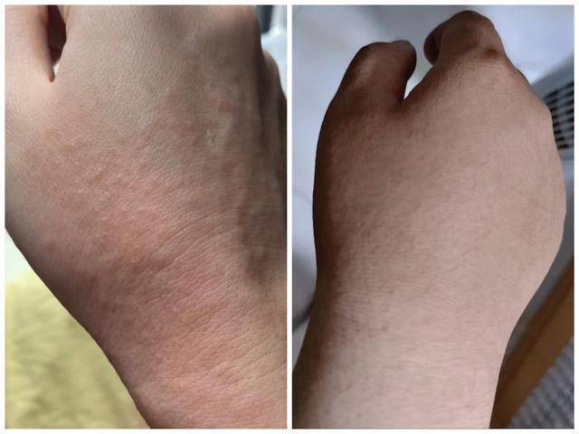 再发最后一遍！被问了800遍的祛湿疹妙招，亲测有效不踩雷