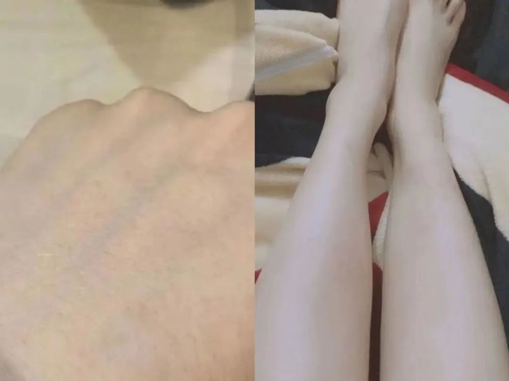 湿疹痒红疹用什么药最有效？3个方法，拥有健康皮肤！