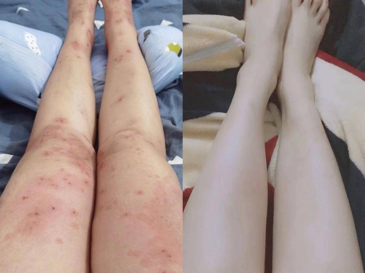 慢性湿疹要怎么才能治好？六年老湿疹患者的经验之谈