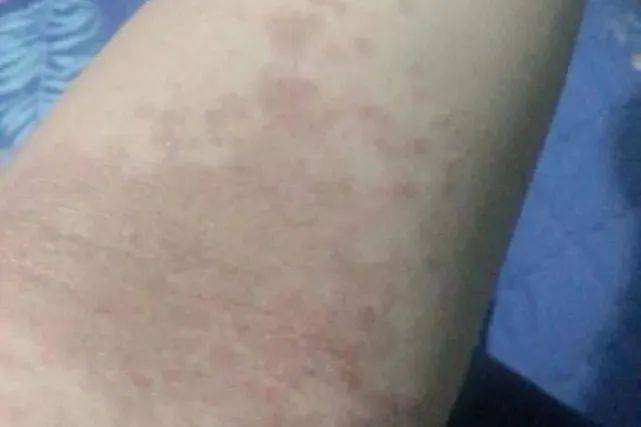 湿疹止痒最有效的方法？助你摆脱湿疹困​扰！