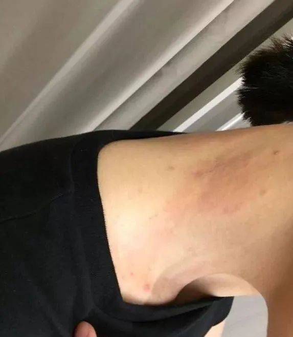 湿疹止痒最有效的方法？助你摆脱湿疹困​扰！