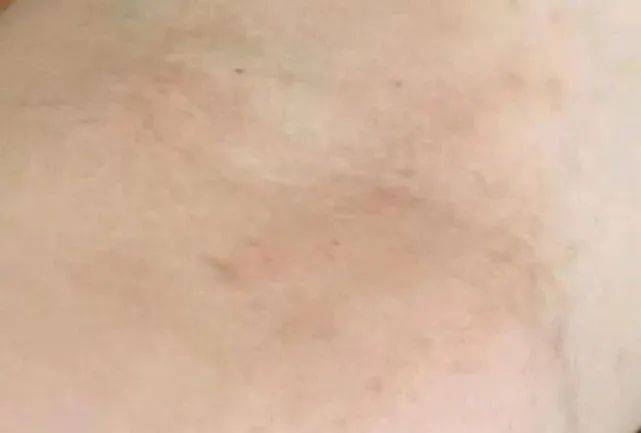 湿疹止痒最有效的方法？助你摆脱湿疹困​扰！