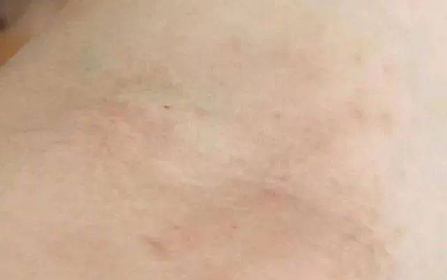 湿疹止痒最有效的方法？助你摆脱湿疹困​扰！